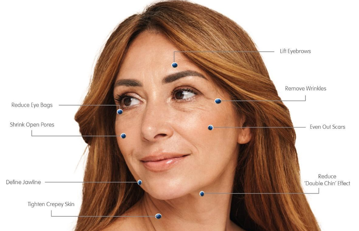 Microneedling Triggers