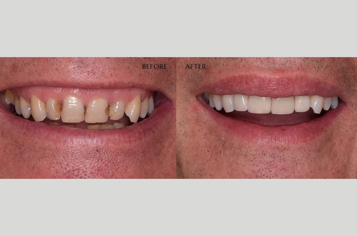 Free Smile Makeover Consultations